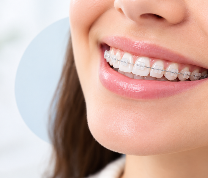 Ceramic Braces