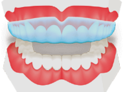 Mouthguards-copy-1