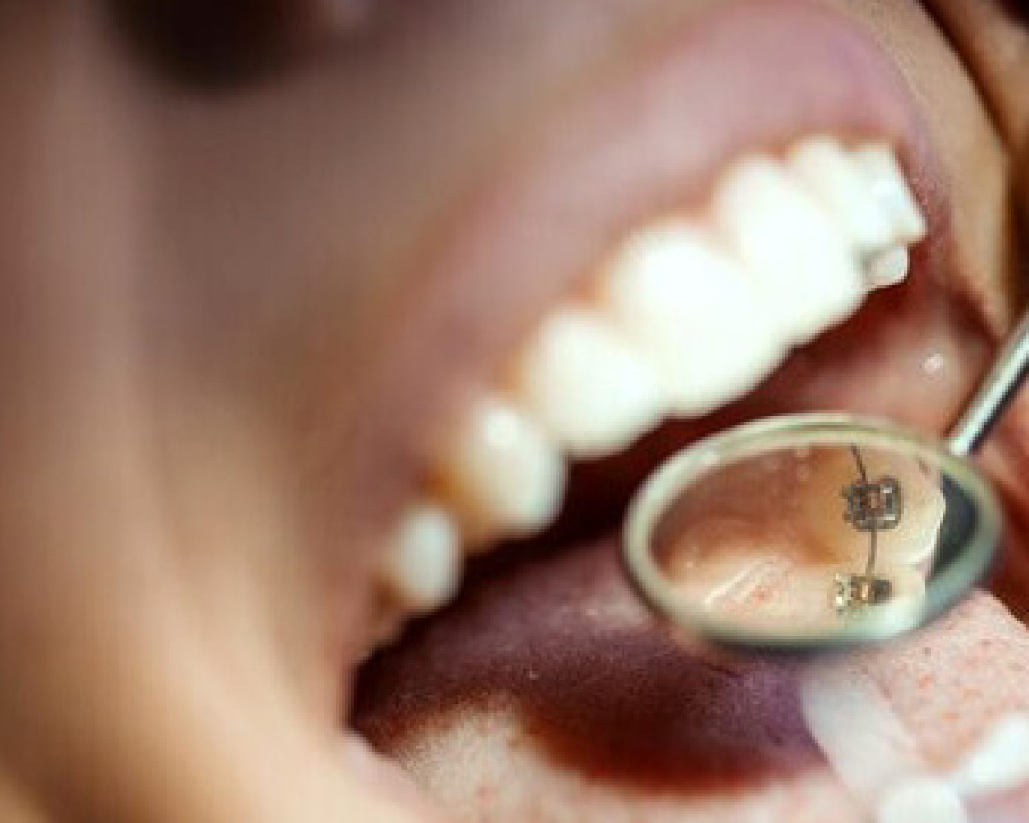 beautiful-young-woman-is-dentist-she-sits-dentist-s-chair-dentist-repair-her-teeth-close-up_360066-10225 (1)