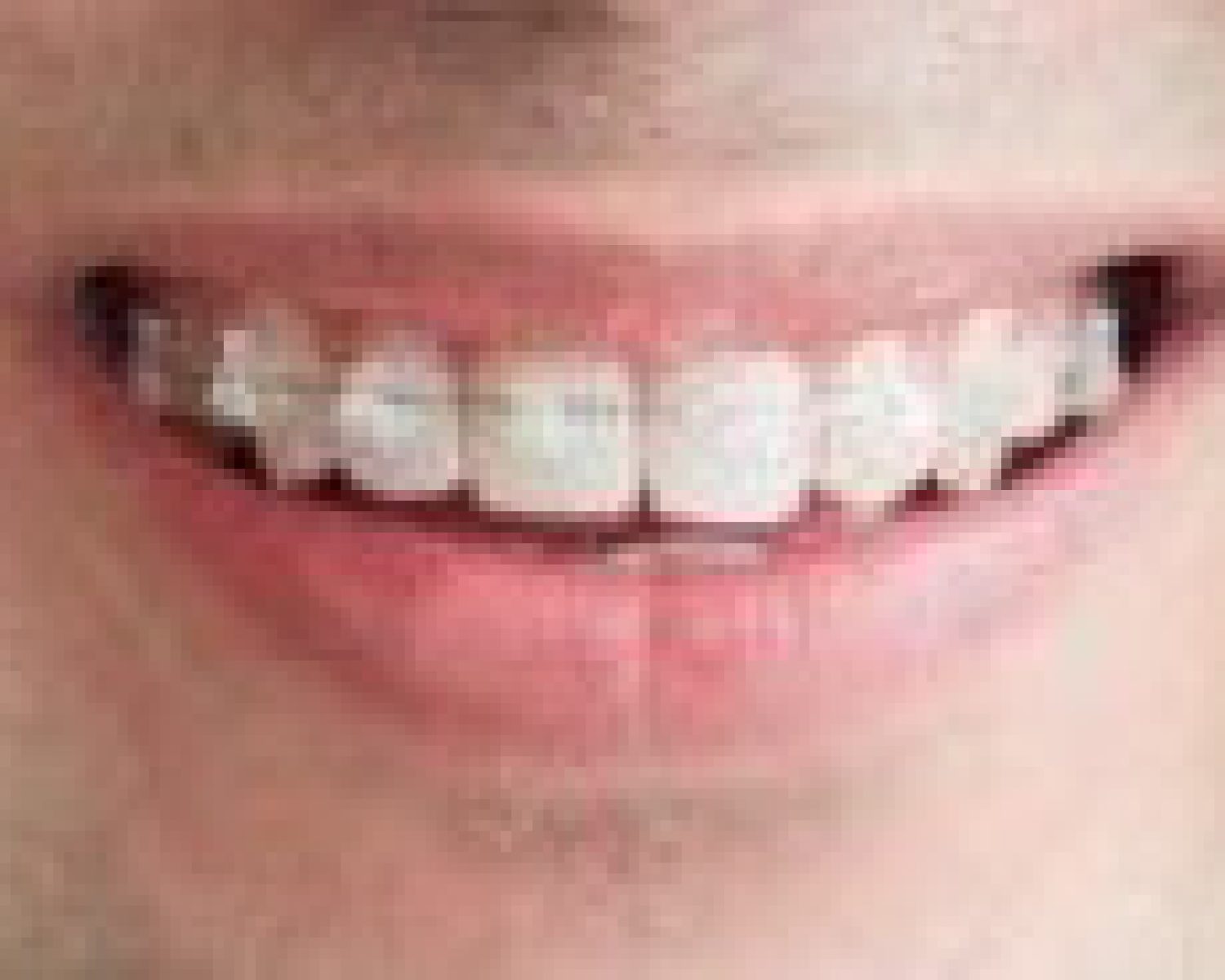 ceramic-braces (1)