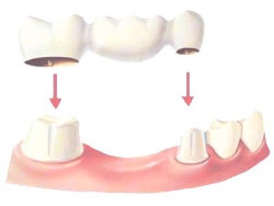 dental-bridges