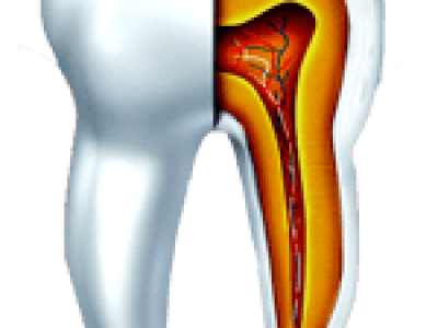 root-canel-copy-1