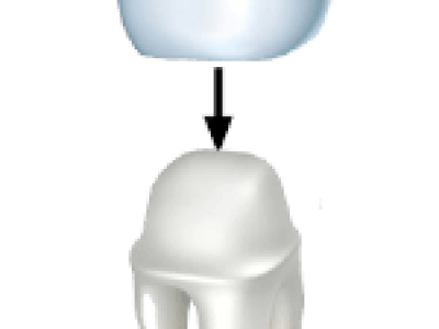 tooth-crowns-copy