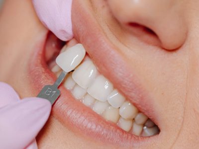 veneers